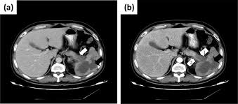 Image result for Splenic Abscess