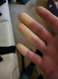 𝗜𝘁'𝘀 𝗥𝗮𝘆𝗻𝗮𝘂𝗱'𝘀 𝗔𝘄𝗮𝗿𝗲𝗻𝗲𝘀𝘀 𝗠𝗼𝗻𝘁𝗵 ❄️ Raynaud's is  more than just cold fingers &mdash; it can be painful, exhausting, and can impact  day-to-day life. We're sharing this post from Scleroderma & Raynaud's UK -