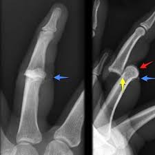 Image result for Interphalangeal Dislocation