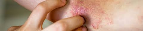 Image result for Eczema nummulare