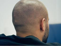 This procedure was completed by skalp clinic in london. Guys Are Tattooing Hair Onto Their Bald Heads Gq