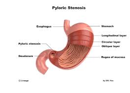 Congenital Pyloric Stenosis Gastrointestinal Medbullets