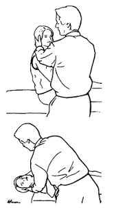 Image result for Canalith Repositioning Procedure