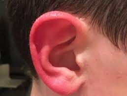 Red Ear Syndrome Dermnet Nz