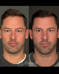 Meet Dr. Neil Fine! ✨ He started performing breast reconstruction when he  arrived at Northwestern in 1994. He was a part of the employed University  practice for 15 years. He then went