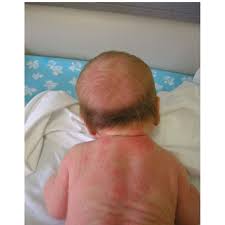 In other babies, the process happens quickly and your newborn may go completely bald in a matter of days. Transient Neonatal Hair Loss Some Babies Already Show At Birth The Download Scientific Diagram