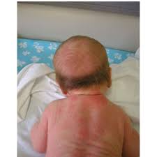 Do not worry at all! Transient Neonatal Hair Loss Some Babies Already Show At Birth The Download Scientific Diagram