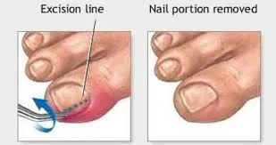 Image result for Toenail Removal