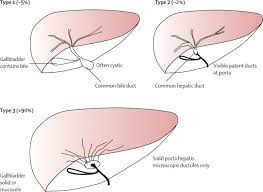 Overview biliary colic is a dull pain in the middle to upper right area of the abdomen. Biliary Atresia The Lancet