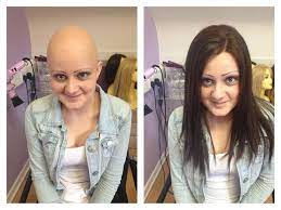 Beautiful Shot Of One Of My Clients Before And After I Fitted Her With Her New Follea Gripper2 Hair This Young Lady Is An Inspiration To Britye Golovy Brite