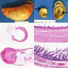 Post Inflammatory Mucosal Hyperplasia And Appendiceal Diverticula Simulate Features Of Low Grade Appendiceal Mucinous Neoplasms Modern Pathology