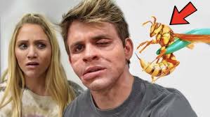 Terrible Allergic Reaction On My Face From A Bee Sting...