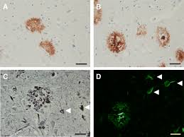 The role of amyloid plaques in alzheimer's disease has puzzled scientists ever since alois alzheimer first described them in the brain of a woman with young onset dementia. The Neuropathological Diagnosis Of Alzheimer S Disease Molecular Neurodegeneration Full Text