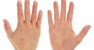 De ce ma simt tristă? Mare AtenÈie Ai Mainile RoÈii Te MÄnancÄ Èi Te UsturÄ Organismul Te AtenÈioneazÄ CÄ Ai O Serie De Boli Care Trebuie Tratate Imediat Antena 1