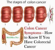 8 common myths about colon cancer. 10 Colon Canser Ideas Health Colon Cancer Awareness Colon