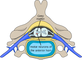 Motor Neuron Disease Wikipedia