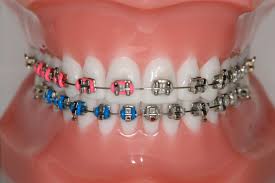 Black And Light Blue Braces Shocking Pink Blue Teeth Braces Braces Bands Braces Colors