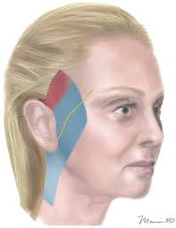 Endoscopic, “Scarless” Composite Flap Face and Neck Lift
