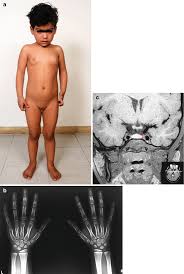 Image result for Precocious Puberty