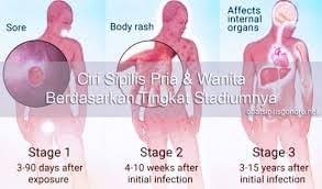 Pemuda no.21 rt.06 rw.01 desa cibeunying kec majenang kab. Ciri Penyakit Sipilis Pada Laki Laki