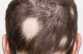 Stress can be controlled and managed. Hair Loss Due To Stress Will It Grow Back