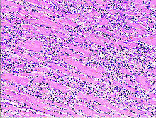 Although this condition is rare, the myocarditis foundation is hard at work raising awareness and working on finding a cure. Pathology Heart Wikibooks Open Books For An Open World