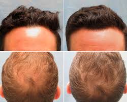 Hope of a future treatment for hair regrowth. Prp Hair Loss Therapy Treatment In Mexico 350