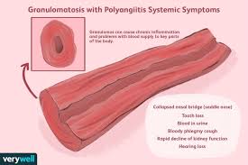 Image result for Microscopic Polyangiitis