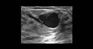 Mammasonographie Erganzt Mammografie Ultraschall Bei Dichter Brust