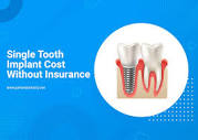 How Much Does Single Tooth Implant Cost Without Insurance? – Prime ...