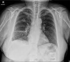Pleural effusion is a condition in which excess fluid builds around the lung. Parapneumonic Effusion Loculated Radiology Case Radiopaedia Org
