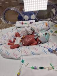 Nash was born at just 21 weeks and weighed only 10 ounces. Doctors didn't  have high hopes for his survival — no baby had ever been born so  prematurely and survived. One