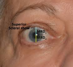 Graves' eye disease, also called graves' ophthalmopathy, is a problem that develops this swelling causes exophthalmos, an abnormal protrusion of the eye, commonly associated with graves' disease. Thyroid Eye Disease Workup And Diagnosis