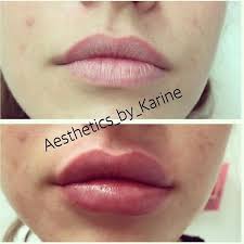 After you (as the host) have set your party. Before After Used 1 Syringe Of Juvederm Ultra Plus Xc Beforeafter Juvederm Syringe Ultra Xc Before After Used Restylane Lips Restylane Lip Fillers