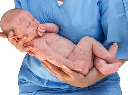 Virus tersebut mempunyai kemampuan untuk menjangkiti orang lain walaupun dalam jumlah yang kecil dan ia mampu hidup selama 2 jam di persekitaran luar. Anak Sakit Campak Bisa Sembuh Sendiri Dengan Ditunggui Ini Penjelasan Dokter