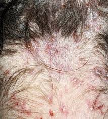 Nutrition Fitness Medical Wellness Head Lice Infestation Head Louse Head Itch
