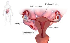 In endometriosis, tissue that looks and acts like endometrial tissue implants outside the uterus.this can cause pain, heavy periods, and infertility. Endometriosis Belly And Body Care