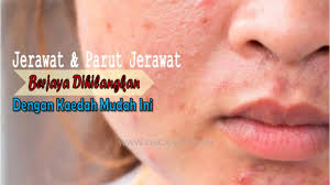 Tip ni abah rajin buat waktu sekolah menegah dulu. Cara Hilangkan Parut Jerawat Untuk Wajah Kembali Cantik Ohcantik Com