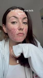 Effective Acne Treatment: Say Goodbye to Breakouts!