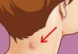 Pisicile pot dezvolta umflaturi mici (papule) sau proeminențe mai mari (noduli) pe pielea lor. Umflaturi Sub Piele Nodui Crescaturi Ce Ar Putea Fi Lataifas