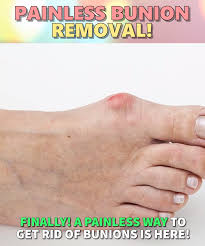 Non Invasive Foot Relief 4 9 5 From Over 2500 Reviews Skincarepimpleshomeremedies Bunion Remedies Feet Care Bunion Relief