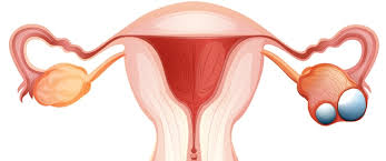 Endometriosis is a full body condition in which cells similar to those in the endometrium, the layer of tissue that normally covers the inside of the uterus, grow outside the uterus. Ø£Ø³Ø¨Ø§Ø¨ ÙˆØ£Ø¹Ø±Ø§Ø¶ ÙˆØªØ´Ø®ÙŠØµ Ø§Ù„Ø¥ØµØ§Ø¨Ø© Ø¨Ø³Ø±Ø·Ø§Ù† Ø§Ù„Ù…Ø¨ÙŠØ¶ ÙˆÙŠØ¨ Ø·Ø¨