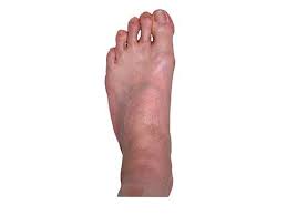 Pin On Foot And Ankle Sports Injuries