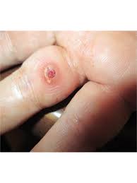 Image result for Pyogenic Granuloma