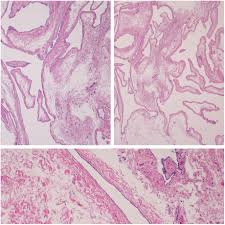 A collection of surgical pathology images. Remote Recurrence Of Benign Multicystic Peritoneal Mesothelioma Journal Of Obstetrics And Gynaecology Canada
