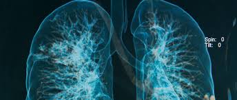 Síndrome resultante de la migración de trombos venosos hacia la circulación pulmonar que ocasiona. Los Sintomas De Una Embolia Pulmonar Tratamiento Y Recuperacion