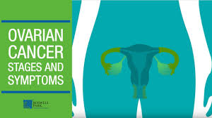Persistence of symptoms is key. Understanding Ovarian Cancer Stages And Symptoms Youtube