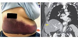 Apalagi saat tubuh semakin tua, kondisi tulang semakin rapuh dan kemampuan ototpun menurun sehingga sakit pinggang tidak bisa dihindari. Batuk Terlalu Keras Wanita Ini Patahkan Tulang Rusuknya Kok Bisa Halaman All Kompas Com
