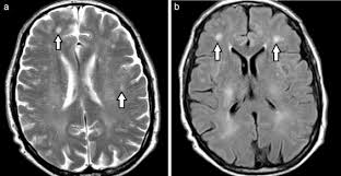 En la exploración neurológica puede encontrarse oftalmoplejía internuclear y afección difusa del sistema nerviosos central. Lesiones En La Sustancia Blanca En El Paciente Anciano Utilizacion De La Terminologia Adecuada Sciencedirect