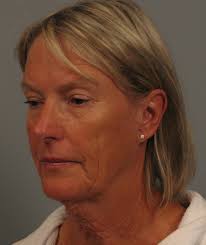 Facelift Before and After Photos by Gregory Mackay, MD; Atlanta, GA